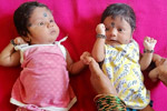 surrogacy cost in 
Hyderabad