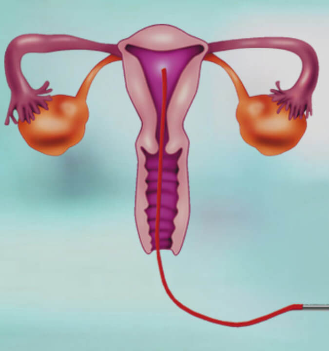 ivf Hospitals in Hyderabad India